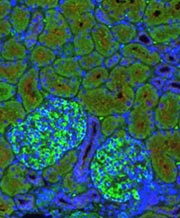Alport syndrome case study