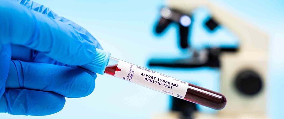 A sample of blood used to test for Alport syndrome.