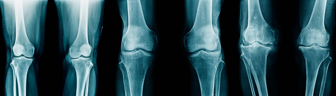 Stages of knee joint degeneration
