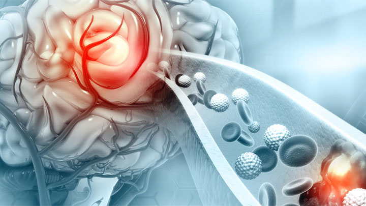 A 3D illustration of a blood clot in the vessels of the human brain.