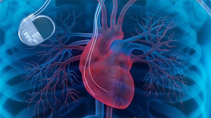 Illustration of a person's chest showing the heart and lungs, and a pacemaker.