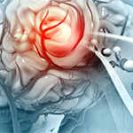 A 3D illustration of a blood clot in the vessels of the human brain.