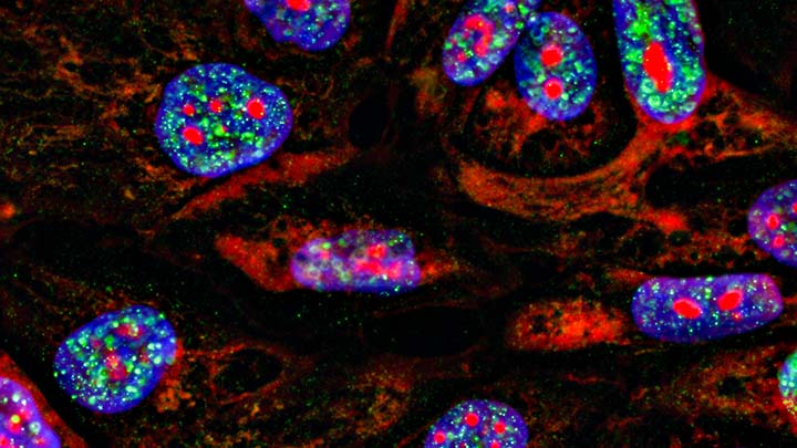 Immunofluorescence image of cancer cells.