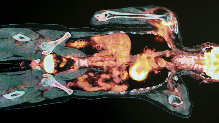 PET scan of body, anterior posterior view.