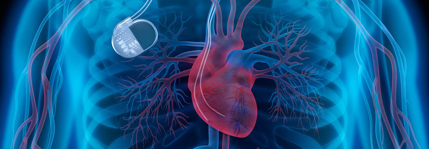 Illustration of a person's chest showing the heart and lungs, and a pacemaker.