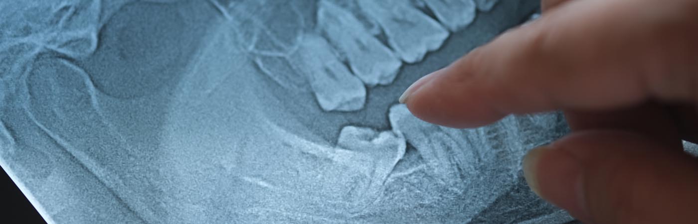 A dentist pointing to a tooth on a dental X-ray.