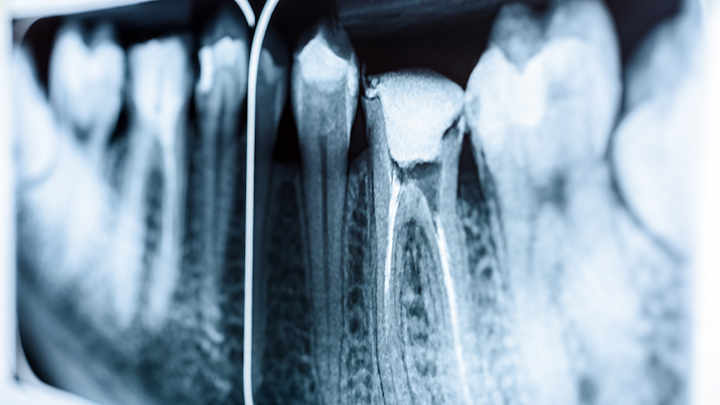 X-rays of a patient's teeth.