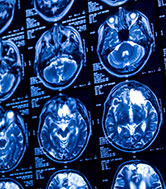 Blue and black medical brain scan images showing different parts of the brain.