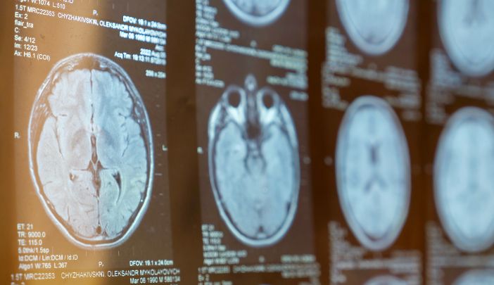 A CT scan of a brain on a screen